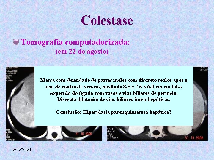 Colestase Tomografia computadorizada: (em 22 de agosto) Massa com densidade de partes moles com