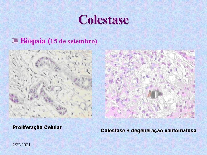 Colestase Biópsia (15 de setembro) Proliferação Celular 2/22/2021 Colestase + degeneração xantomatosa 