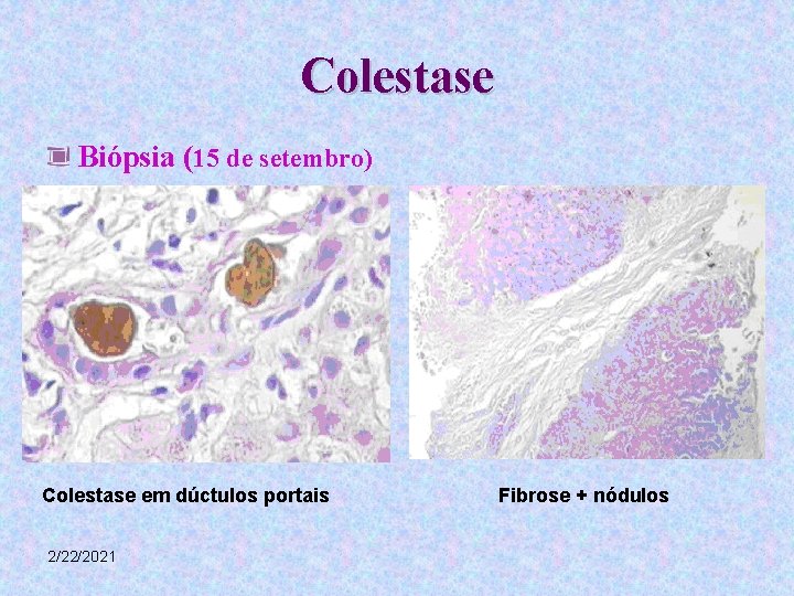 Colestase Biópsia (15 de setembro) Colestase em dúctulos portais 2/22/2021 Fibrose + nódulos 