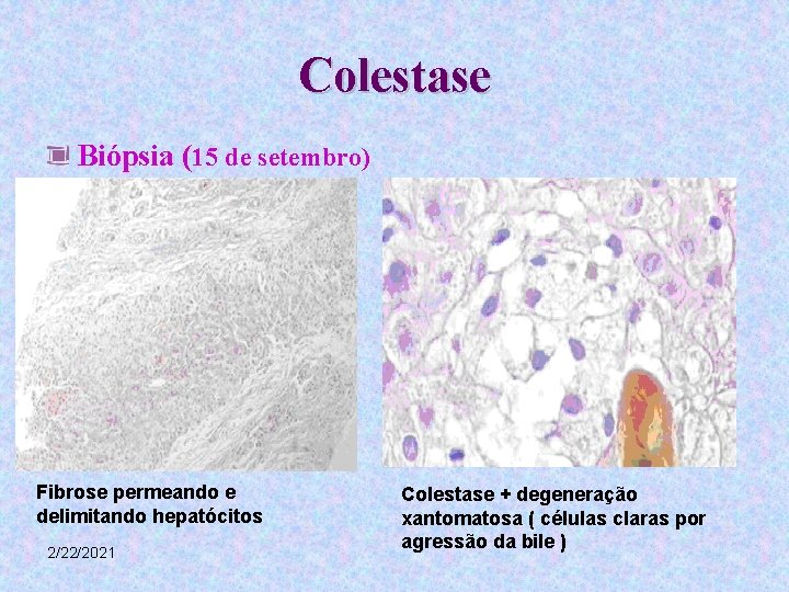 Colestase Biópsia (15 de setembro) Fibrose permeando e delimitando hepatócitos 2/22/2021 Colestase + degeneração