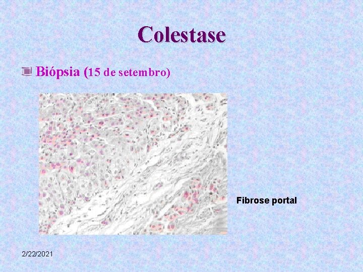 Colestase Biópsia (15 de setembro) Fibrose portal 2/22/2021 