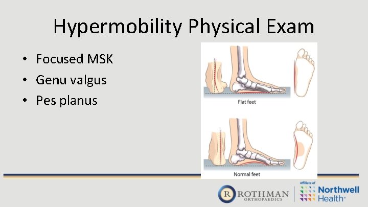 Hypermobility Physical Exam • Focused MSK • Genu valgus • Pes planus 