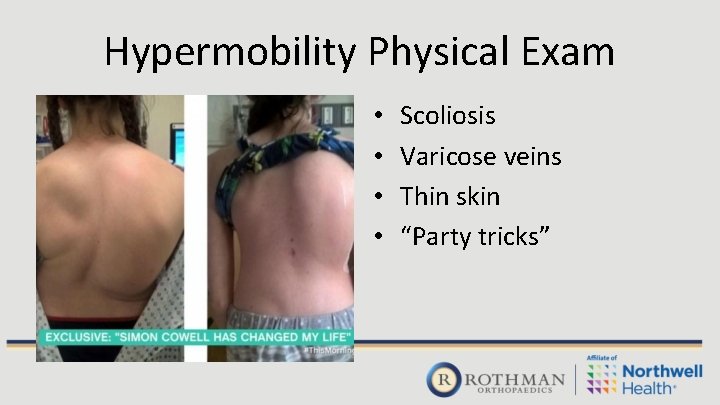 Hypermobility Physical Exam • • Scoliosis Varicose veins Thin skin “Party tricks” 