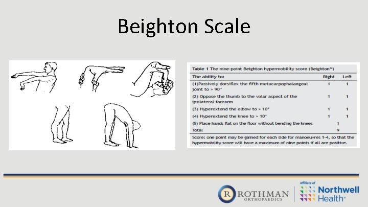 Beighton Scale 