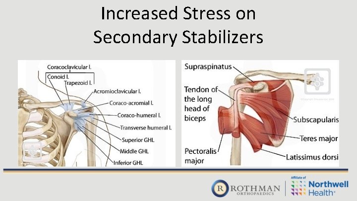 Increased Stress on Secondary Stabilizers 