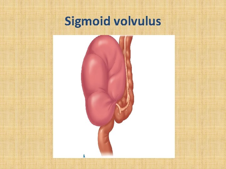 Sigmoid volvulus 