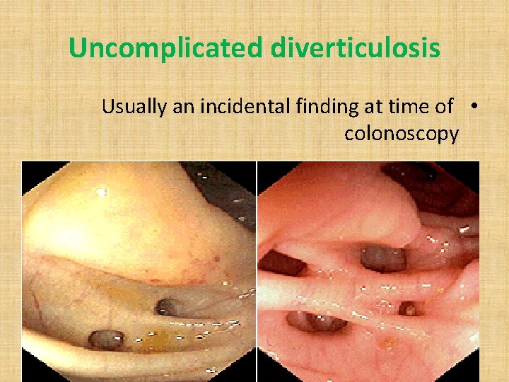 Uncomplicated diverticulosis Usually an incidental finding at time of • colonoscopy 