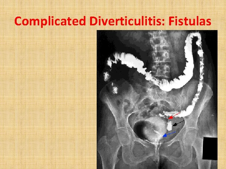 Complicated Diverticulitis: Fistulas 