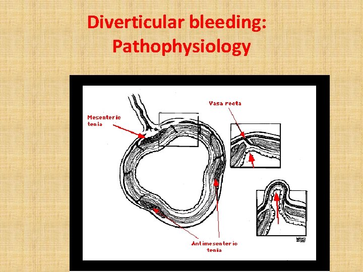 Diverticular bleeding: Pathophysiology 