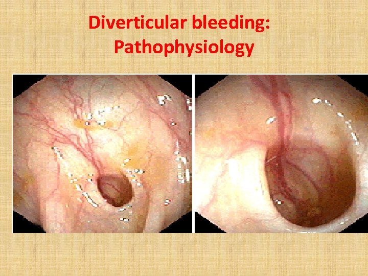 Diverticular bleeding: Pathophysiology 