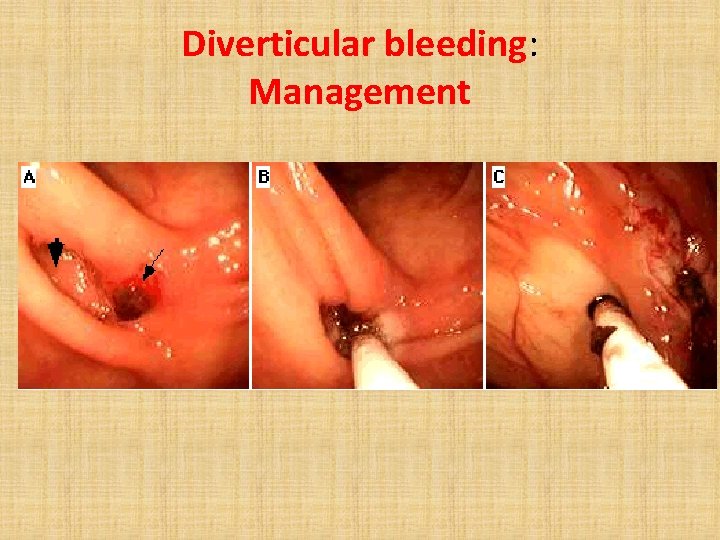 Diverticular bleeding: Management 