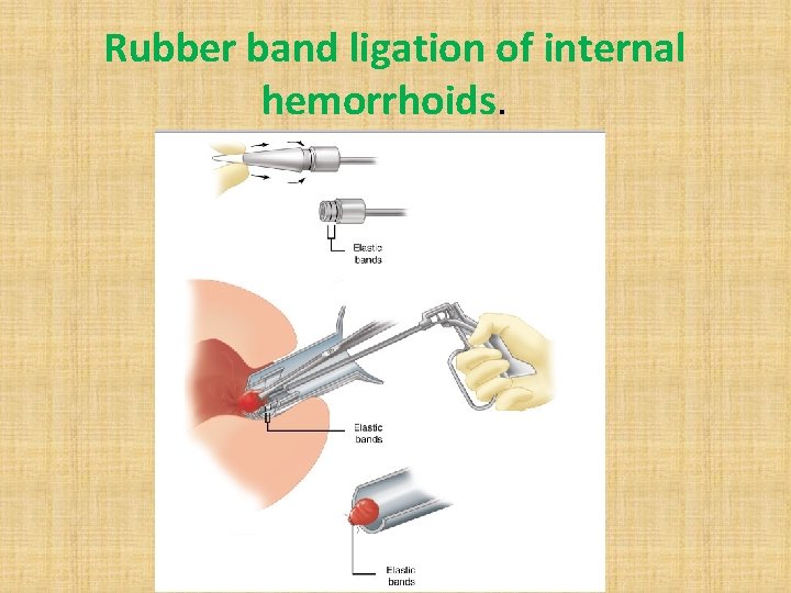 Rubber band ligation of internal hemorrhoids. 