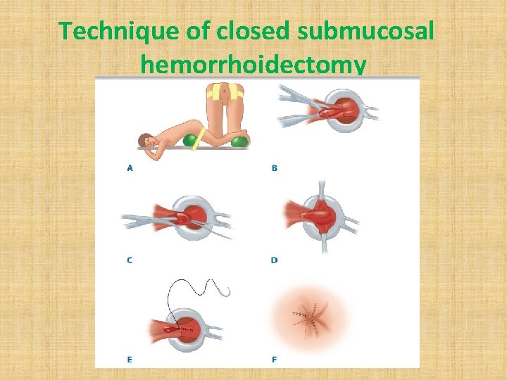 Technique of closed submucosal hemorrhoidectomy 
