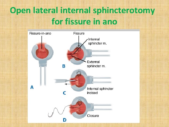 Open lateral internal sphincterotomy for fissure in ano 