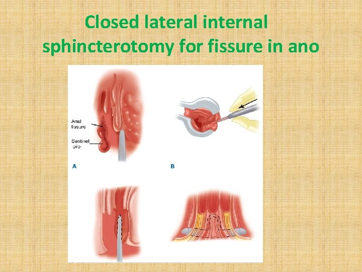 Closed lateral internal sphincterotomy for fissure in ano 