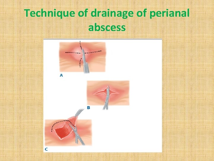 Technique of drainage of perianal abscess 