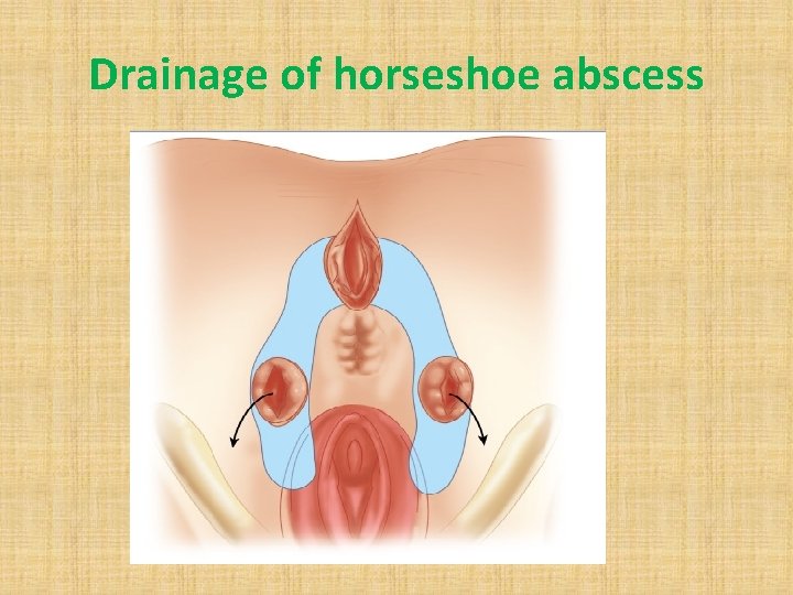 Drainage of horseshoe abscess 