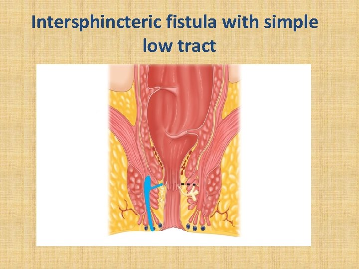 Intersphincteric fistula with simple low tract 