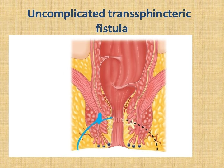 Uncomplicated transsphincteric fistula 