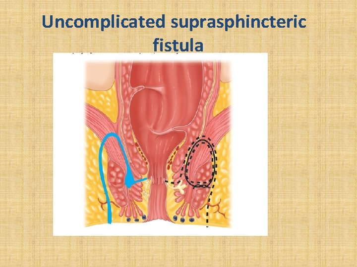 Uncomplicated suprasphincteric fistula 