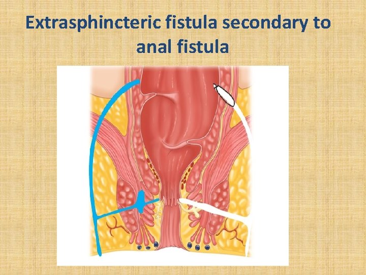Extrasphincteric fistula secondary to anal fistula 