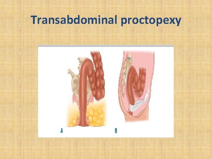 Transabdominal proctopexy 