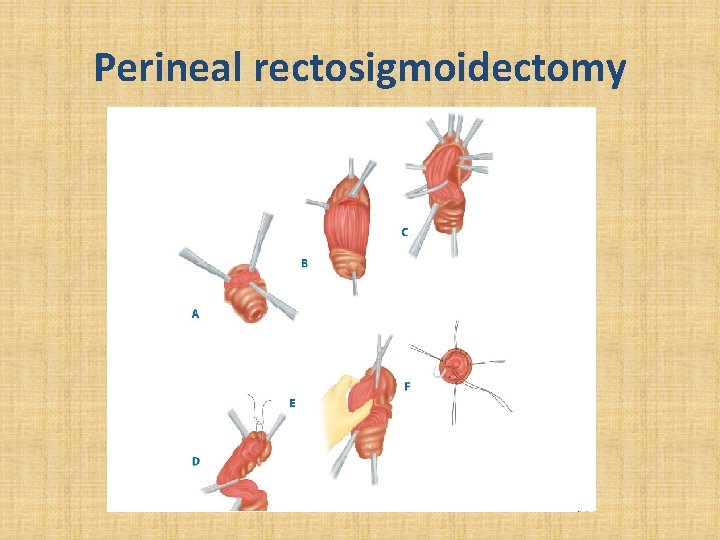 Perineal rectosigmoidectomy 