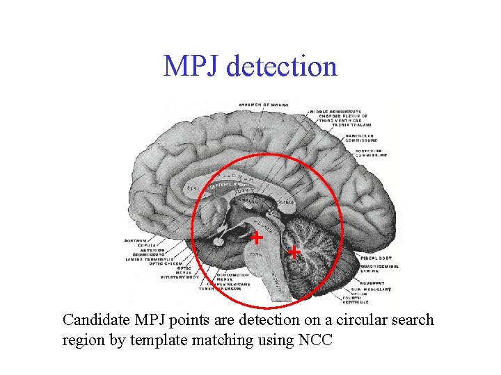 MPJ detection Candidate MPJ points are detection on a circular search region by template