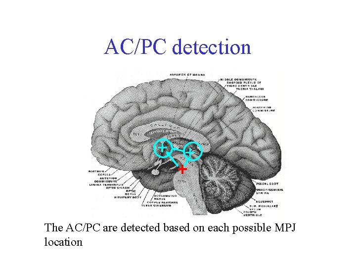 AC/PC detection The AC/PC are detected based on each possible MPJ location 