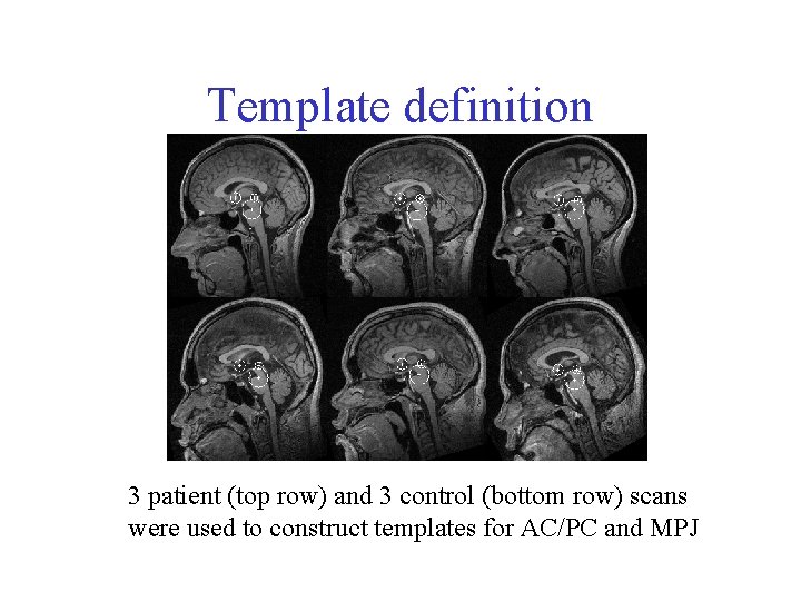 Template definition 3 patient (top row) and 3 control (bottom row) scans were used