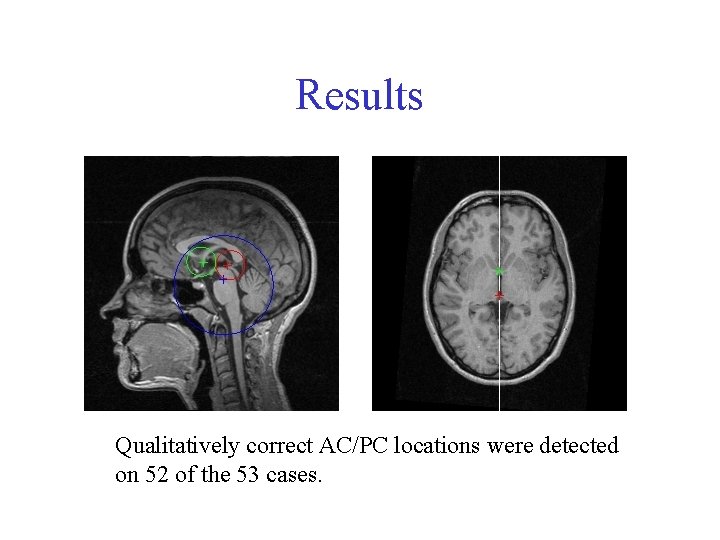 Results Qualitatively correct AC/PC locations were detected on 52 of the 53 cases. 