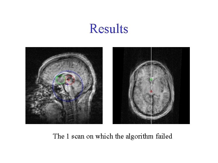 Results The 1 scan on which the algorithm failed 