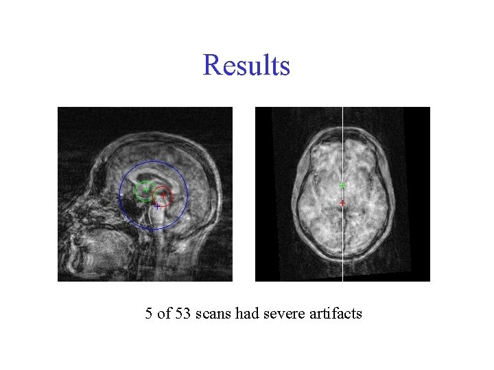 Results 5 of 53 scans had severe artifacts 