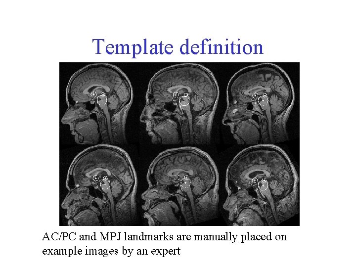 Template definition AC/PC and MPJ landmarks are manually placed on example images by an