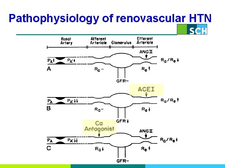 Pathophysiology of renovascular HTN 