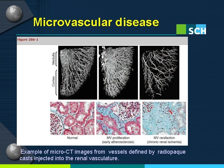 Microvascular disease Example of micro-CT images from vessels defined by radiopaque casts injected into