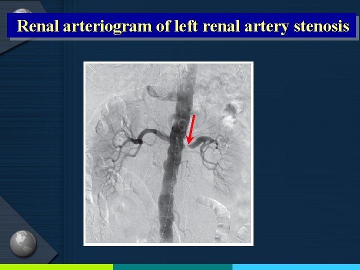 Renal arteriogram of left renal artery stenosis 