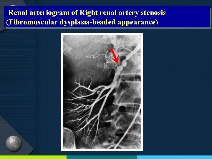 Renal arteriogram of Right renal artery stenosis (Fibromuscular dysplasia-beaded appearance) 