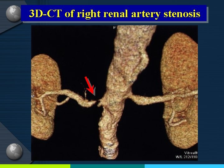 3 D-CT of right renal artery stenosis 