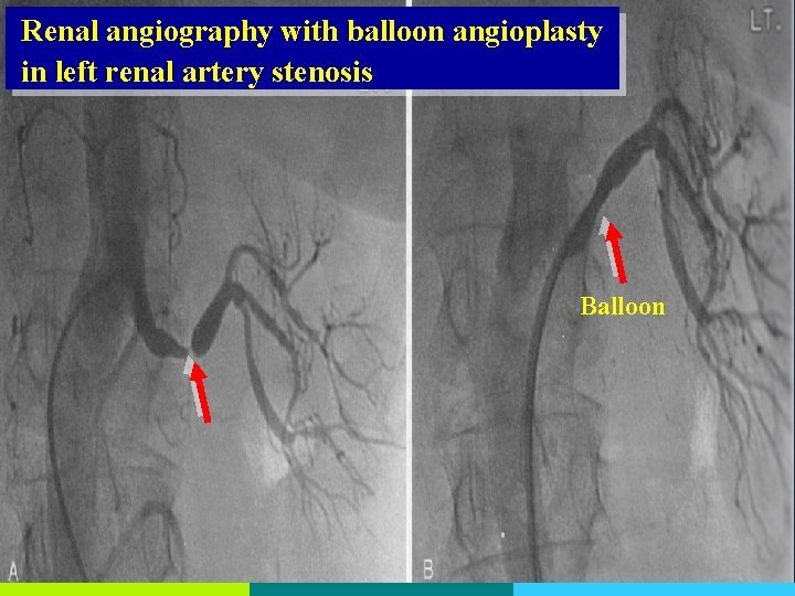 Renal angiography with balloon angioplasty in left renal artery stenosis Balloon 