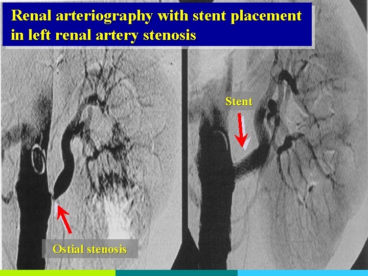 Renal arteriography with stent placement in left renal artery stenosis Stent Ostial stenosis 