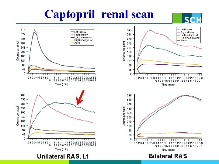 Captopril renal scan Unilateral RAS, Lt Bilateral RAS 