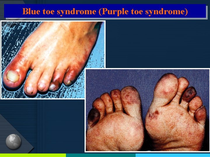 Blue toe syndrome (Purple toe syndrome) 