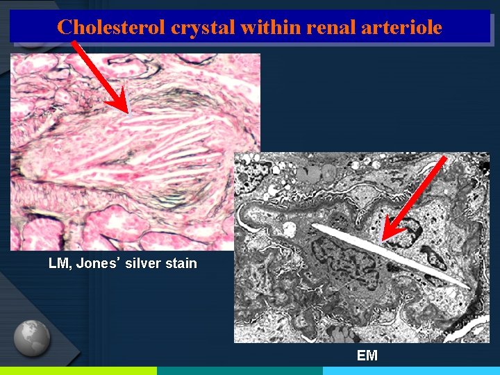 Cholesterol crystal within renal arteriole LM, Jones’ silver stain EM 