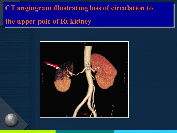 CT angiogram illustrating loss of circulation to the upper pole of Rt. kidney 