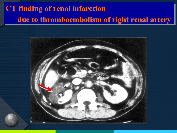 CT finding of renal infarction due to thromboembolism of right renal artery 