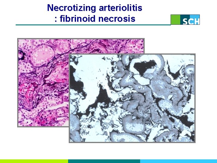 Necrotizing arteriolitis : fibrinoid necrosis 