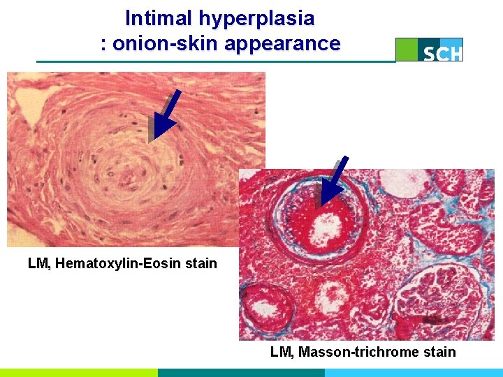Intimal hyperplasia : onion-skin appearance LM, Hematoxylin-Eosin stain LM, Masson-trichrome stain 
