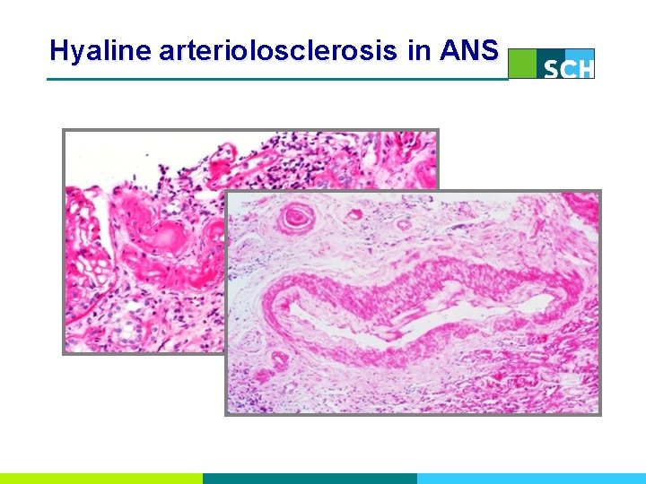 Hyaline arteriolosclerosis in ANS 