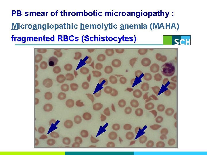 PB smear of thrombotic microangiopathy : Microangiopathic hemolytic anemia (MAHA) fragmented RBCs (Schistocytes) 